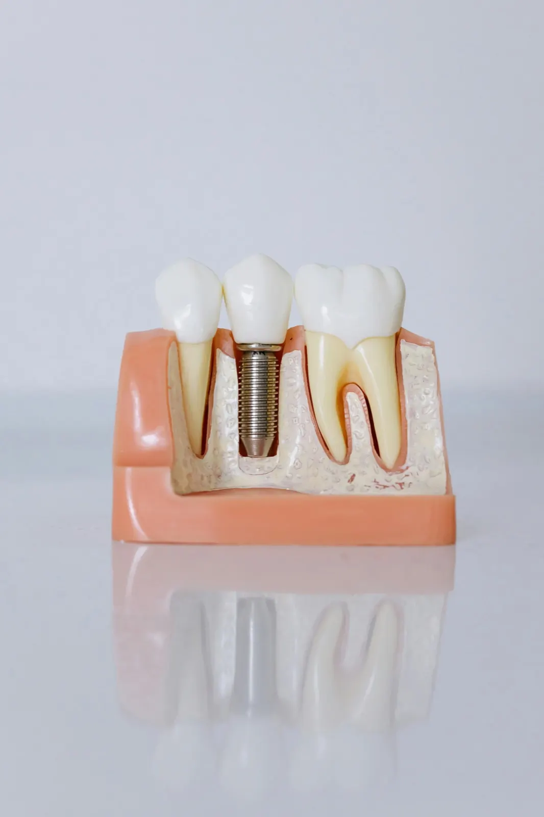 Implantes oseointegrados en Jujuy — Centro Dental Anze